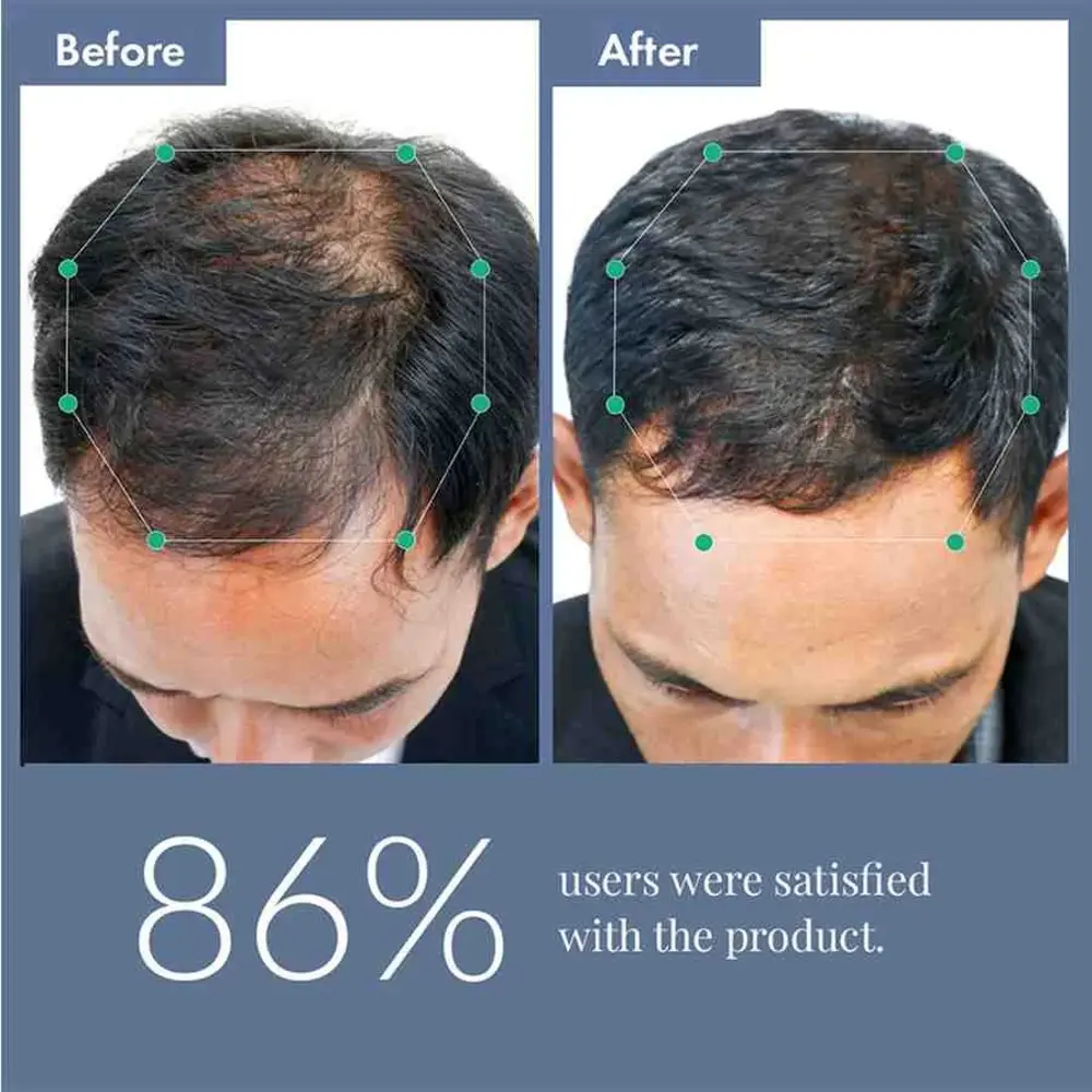 Hair Growth Serum 2.0 For Men & Women, 50ml - Image 10